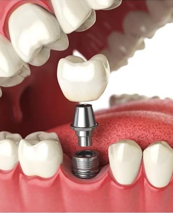 Dental Implants | Paramount Dental | North Calgary | Family and General Dentist