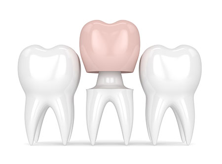 Dental Crowns | Paramount Dental | North Calgary | Family and General Dentist