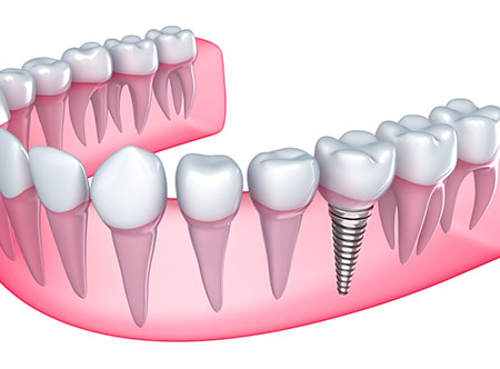 Dental Implants | Paramount Dental | North Calgary | Family and General Dentist