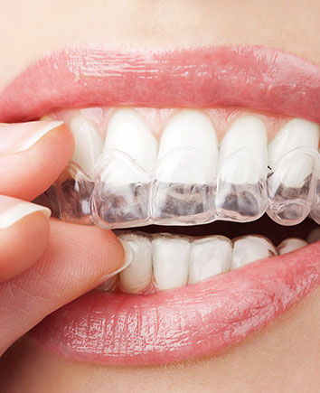 Invisalign Clear Aligners | Paramount Dental | North Calgary | Family and General Dentist