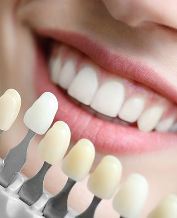 Porcelain Veneers | Paramount Dental | North Calgary | Family and General Dentist