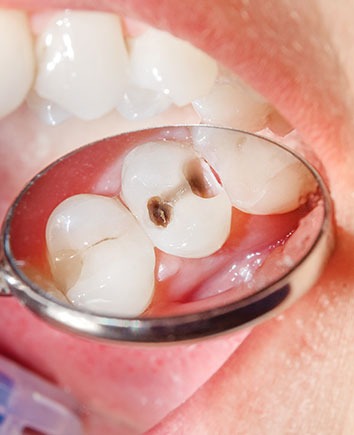 Restorative Dentistry | Paramount Dental | North Calgary | Family and General Dentist