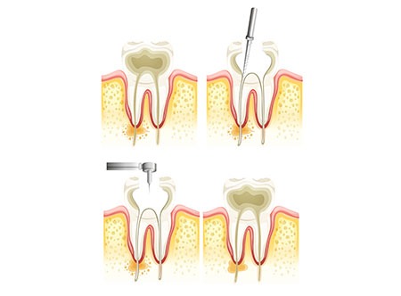 Root Canal Therapy | Paramount Dental | North Calgary | Family and General Dentist