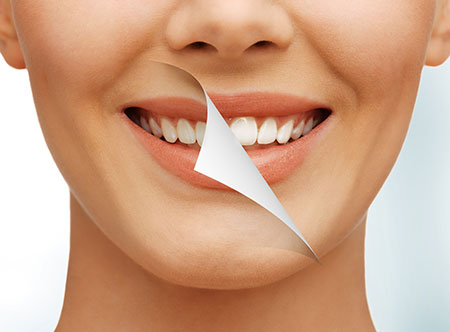 Teeth Whitening | Paramount Dental | North Calgary | Family and General Dentist