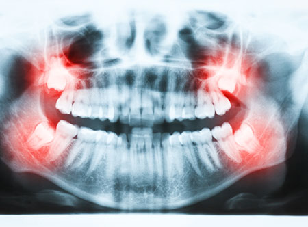 Wisdom Teeth Extractions | Paramount Dental | North Calgary | Family and General Dentist